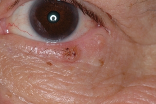 papilloma ocular
